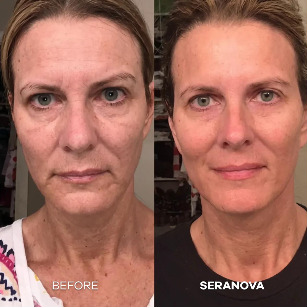 The Micro Infusion System™